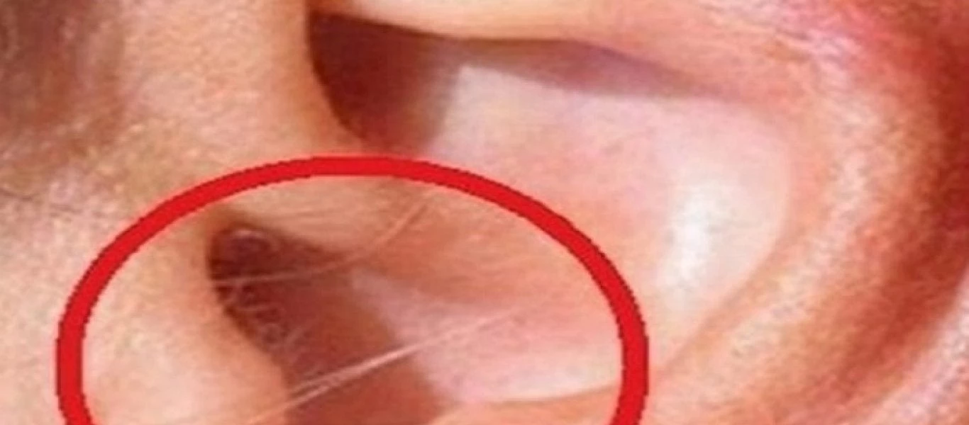 Μεγάλη προσοχή: Δείτε τι σημαίνει αν έχετε τριχοφυΐα στο συγκεκριμένο σημείο του αφτιού!